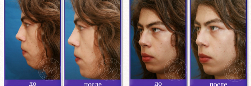 Ринопластика