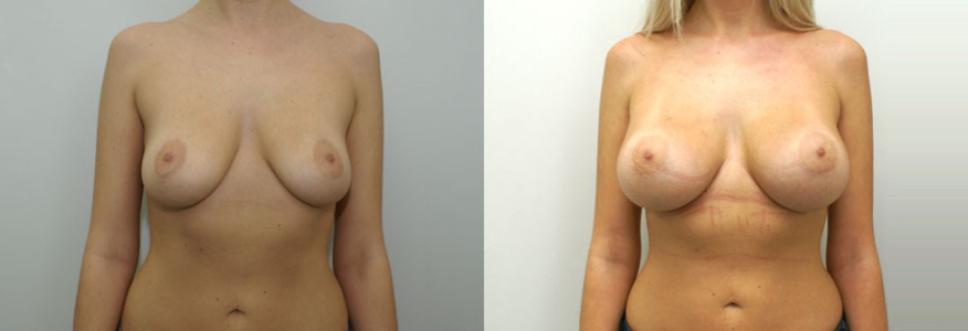 Увеличение груди