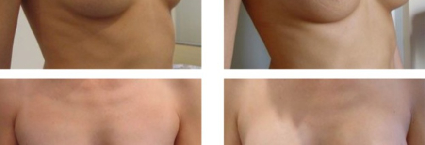 Увеличение груди