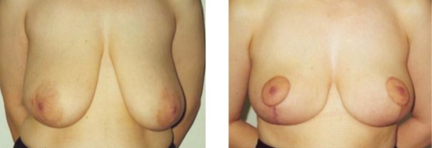 Подтяжка груди