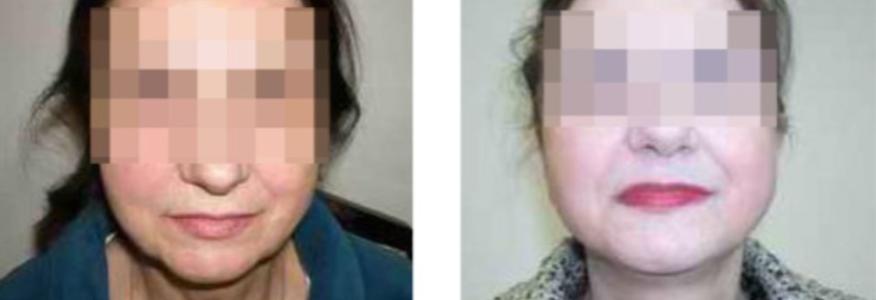 Фейслифтинг
