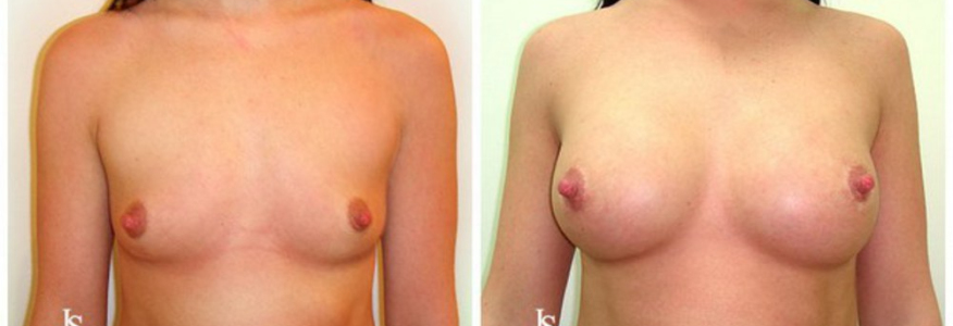 Увеличение груди