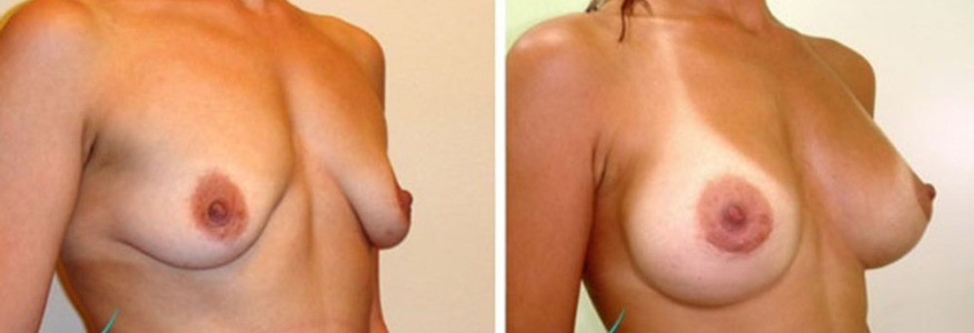 Увеличение груди