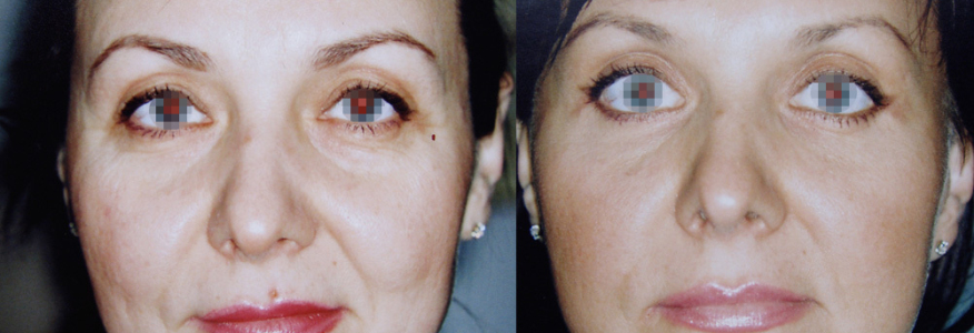 Фейслифтинг