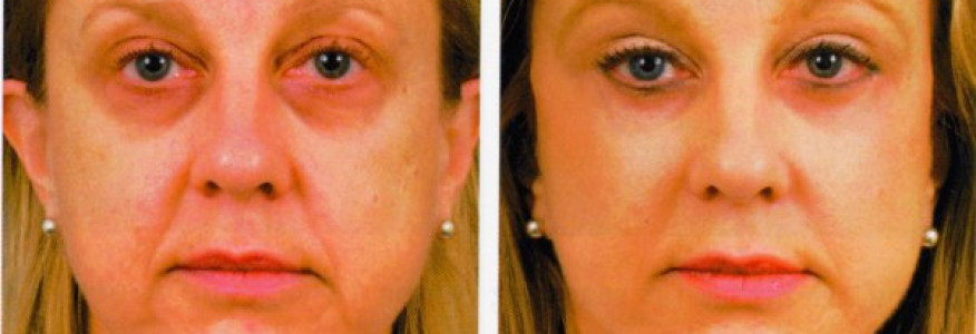 Фейслифтинг