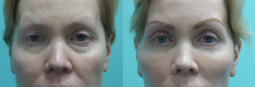 Фейслифтинг