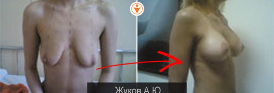 Увеличение груди