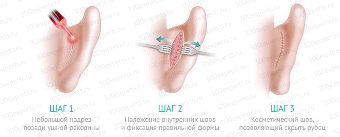 Лазерная отопластика
